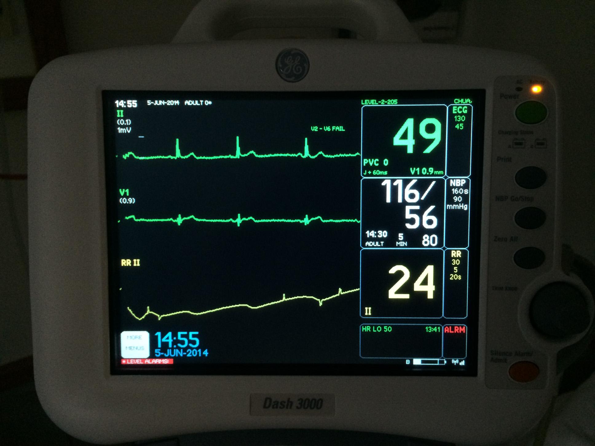 Choosing the Right Blood​ Pressure Monitor for​ Your Needs