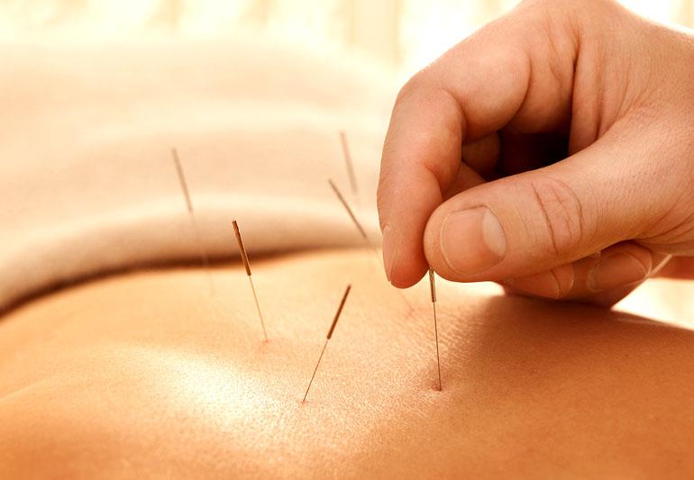 Practical Acupuncture Techniques to Boost Immunity