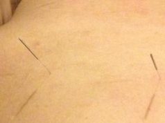 Discover How Acupuncture Restores Balance and Boosts Energy Flow Discover How Acupuncture Restores Balance and Boosts Energy Flow